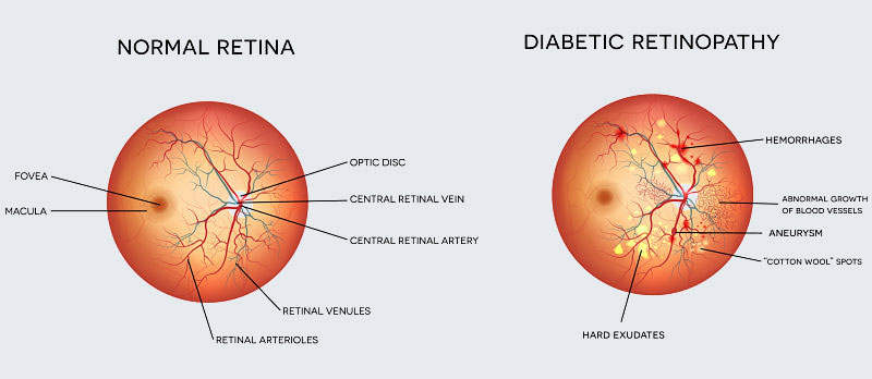 Diabetic Retinopathy