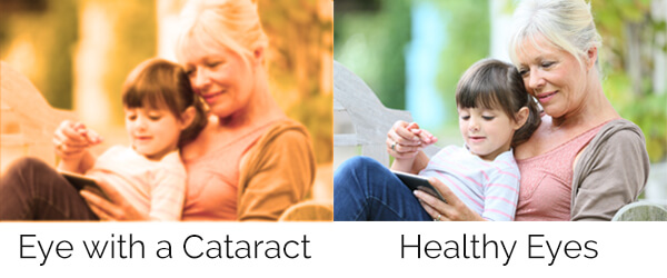 Cataract Comparison 