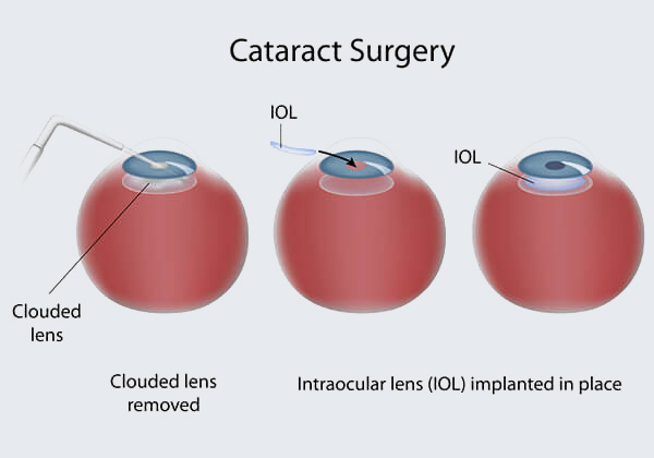 Cataract Treatment Diagram