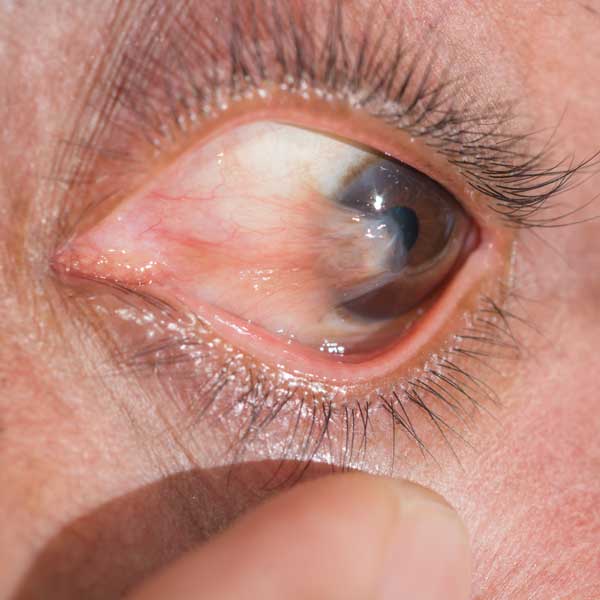 Pterygium Example